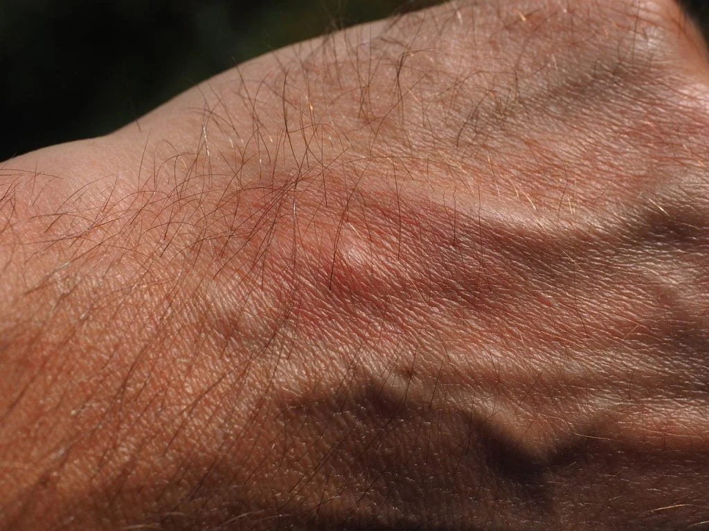A mosquito bite